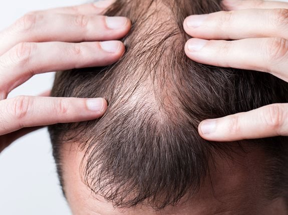 Przechorowanie Covid a wpływ łysienie u kobiet i mężczyzn