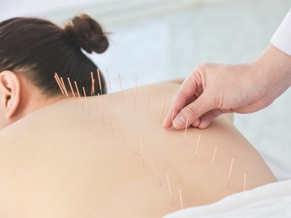 Jak działa akupunktura? Korzyści płynące z akupunktury